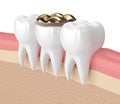 3d render of teeth with dental golden onlay filling Royalty Free Stock Photo