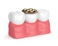 3d render of teeth with dental golden onlay filling Royalty Free Stock Photo