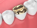 3d render of teeth with dental golden onlay filling Royalty Free Stock Photo