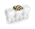 3d render of teeth with dental golden onlay filling Royalty Free Stock Photo