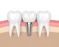 3d render of teeth with dental implant in gums