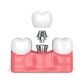 3d render of teeth with dental implant
