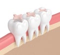 3d render of teeth with dental inlay filling Royalty Free Stock Photo