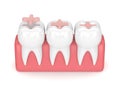 3d render of teeth with dental inlay filling