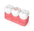 3d render of teeth with dental inlay filling Royalty Free Stock Photo