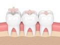 3d render of teeth with dental inlay filling Royalty Free Stock Photo