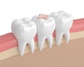 3d render of teeth with dental inlay filling Royalty Free Stock Photo