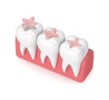 3d render of teeth with dental inlay filling