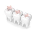 3d render of teeth with dental inlay filling