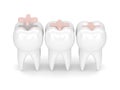 3d render of teeth with dental inlay filling Royalty Free Stock Photo