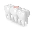 3d render of teeth with dental inlay filling Royalty Free Stock Photo