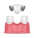 3d render of teeth with dental maryland bridge Royalty Free Stock Photo