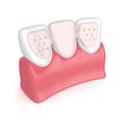 3d render of teeth with dental maryland bridge Royalty Free Stock Photo