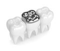 3d render of teeth with dental onlay amalgam filling Royalty Free Stock Photo