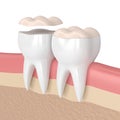 3d render of teeth with dental onlay Royalty Free Stock Photo