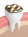 3d render of teeth with dental onlay filling Royalty Free Stock Photo