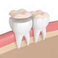 3d render of teeth with dental onlay Royalty Free Stock Photo