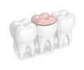 3d render of teeth with dental onlay filling Royalty Free Stock Photo