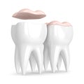 3d render of teeth with dental onlay Royalty Free Stock Photo