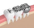 3d render of teeth with different types of dental amalgam filling Royalty Free Stock Photo