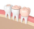 3d render of teeth with different types of dental filling