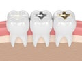 3d render of teeth with different types of dental filling