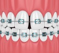 3d render of teeth with divergent diastema and braces