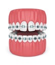 3d render of teeth with divergent diastema and braces