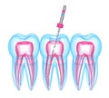 3d render of teeth with endodontic file over white background