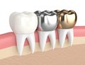 3d render of teeth with different types of dental crown