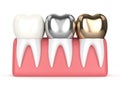 3d render of teeth with different types of dental crown