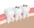 3d render of teeth with different types of dental filling