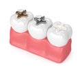 3d render of teeth with different types of dental filling