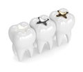 3d render of teeth with different types of dental filling