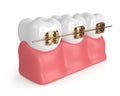 3d render of teeth with golden orthodontic braces