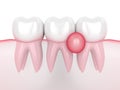 3d render of teeth in gums with cyst