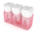 3d render of teeth in gums with cyst Royalty Free Stock Photo