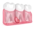 3d render of teeth in gums with cyst Royalty Free Stock Photo