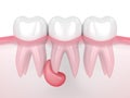 3d render of teeth in gums with cyst Royalty Free Stock Photo