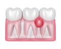 3d render of teeth in gums with cyst Royalty Free Stock Photo