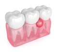 3d render of teeth in gums with cyst Royalty Free Stock Photo
