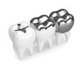 3d render of teeth with different types of dental amalgam filling Royalty Free Stock Photo