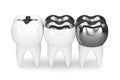 3d render of teeth with different types of dental amalgam filling Royalty Free Stock Photo