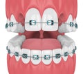 3d render of teeth with orthodontic braces and cavities