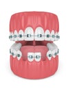 3d render of teeth with orthodontic braces and cavities