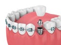 3d render of teeth with orthodontic braces and dental implants