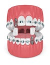 3d render of teeth with orthodontic braces and dental implants