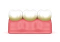 3d render of teeth with plaque and tartar