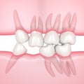 3d render of teeth sliding towards the area of missing tooth in order to fill the gap