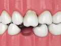 3d render of teeth sliding towards the area of missing tooth in order to fill the gap